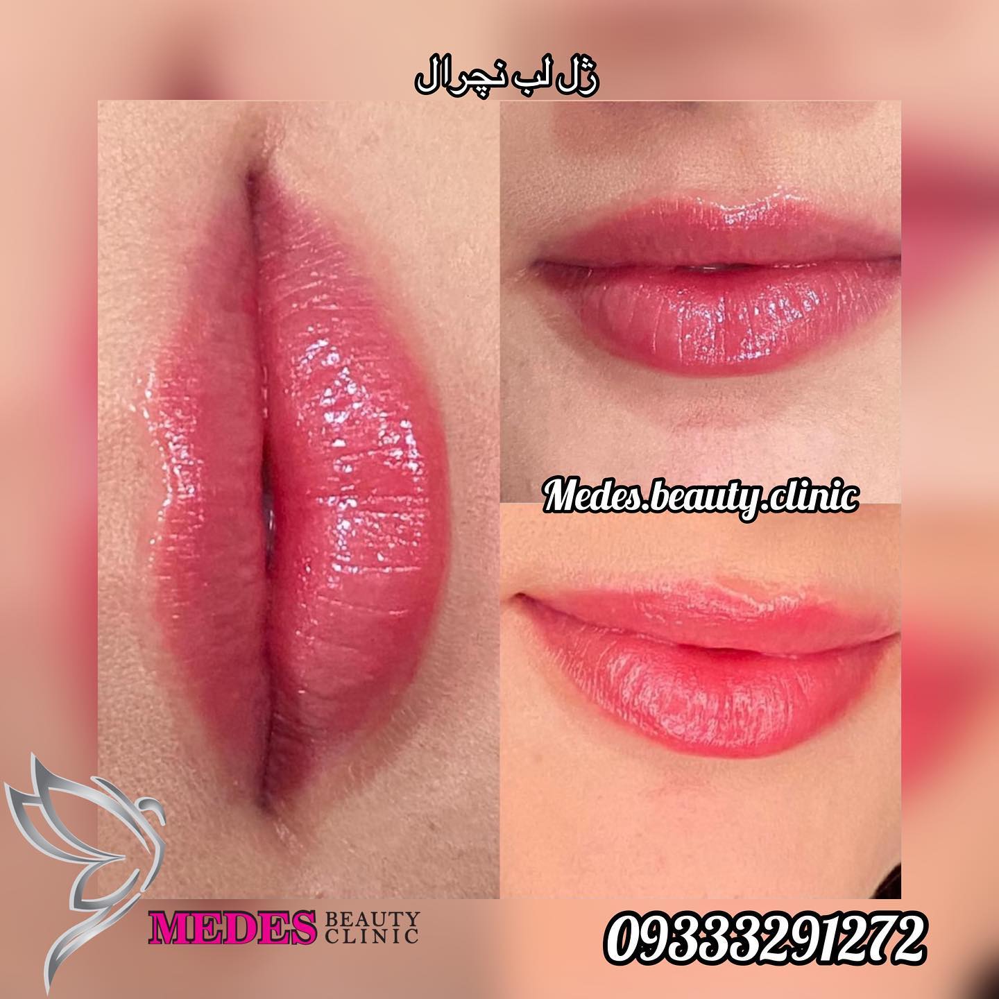 گالری تزریق ژل لب